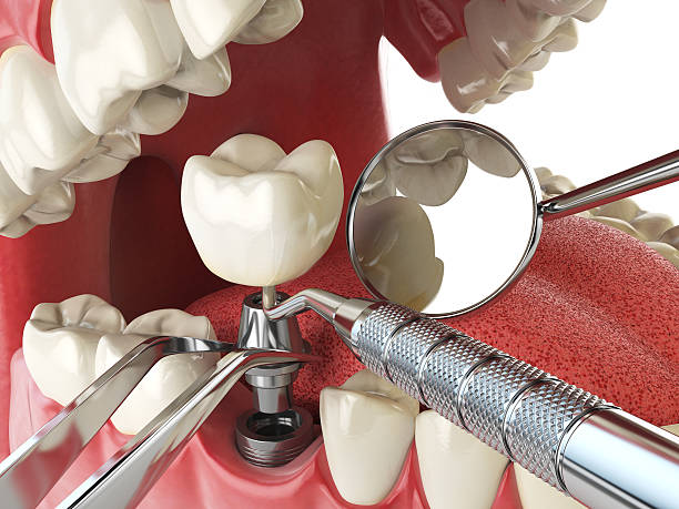 Best Emergency Dental Extractions in Hurlburt Field, FL